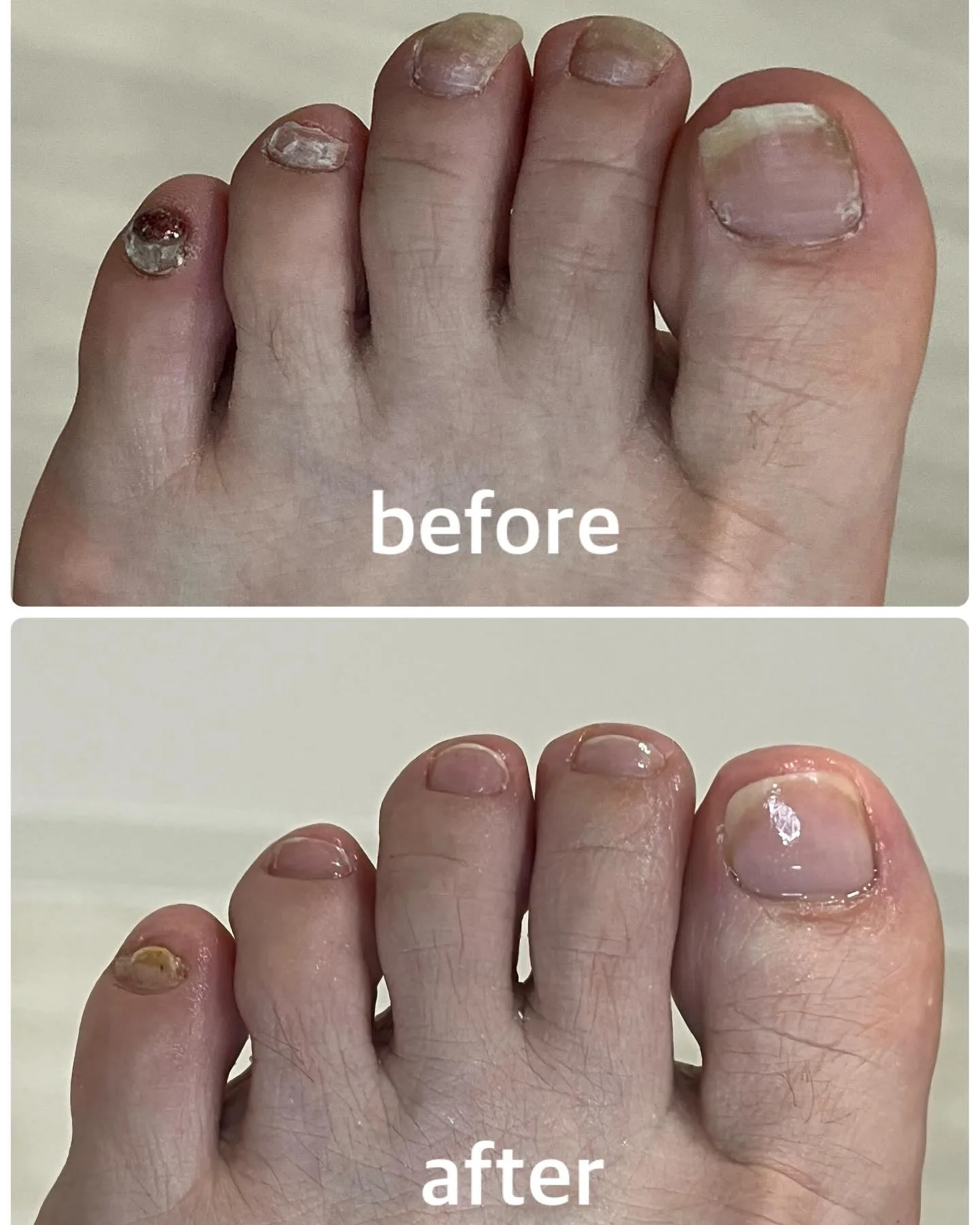 【フットネイルケア before→after】👣✨