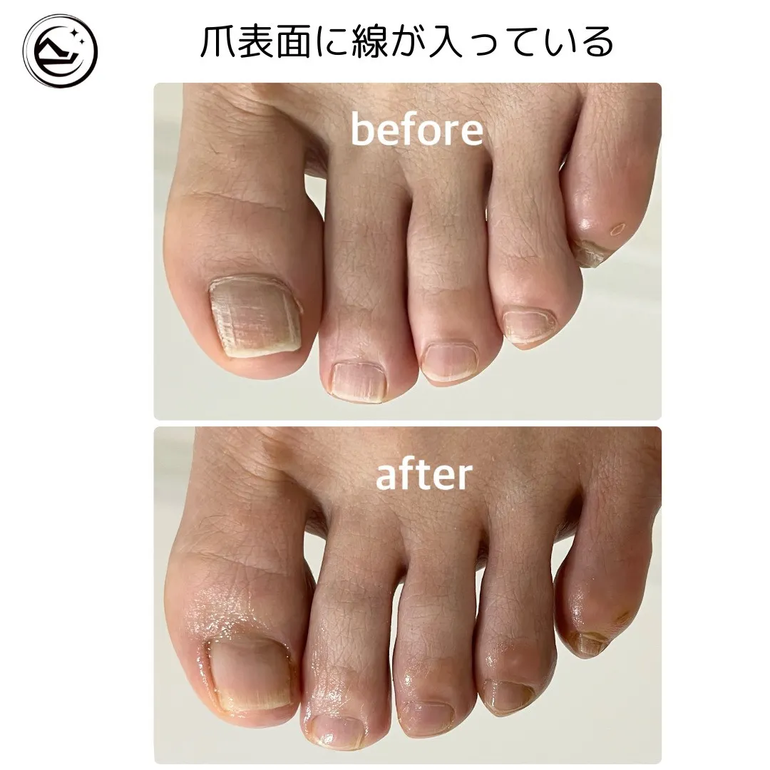 💅【爪に入った縦線、気になっていませんか？】