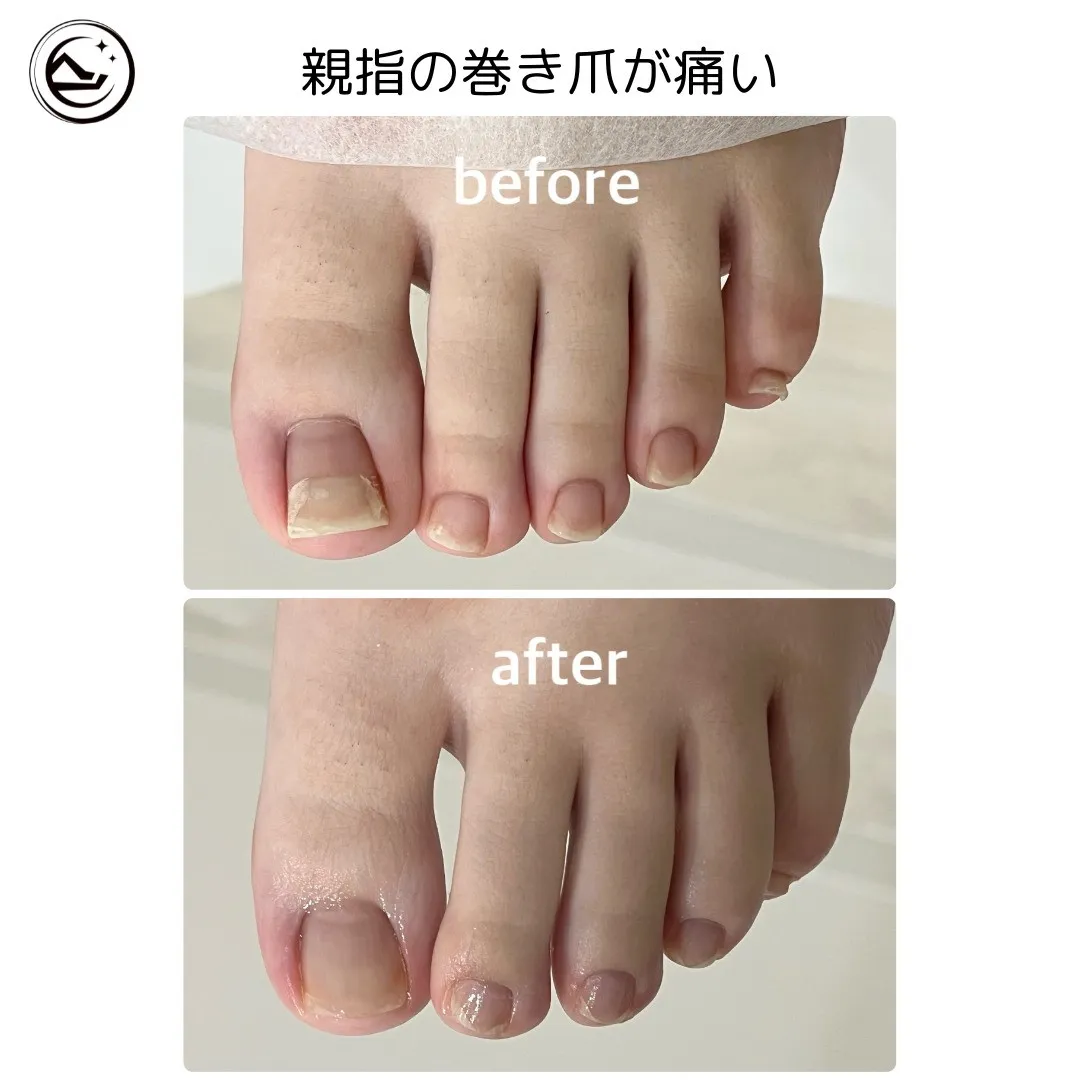 😭【親指の巻き爪が痛くて困っている💥】