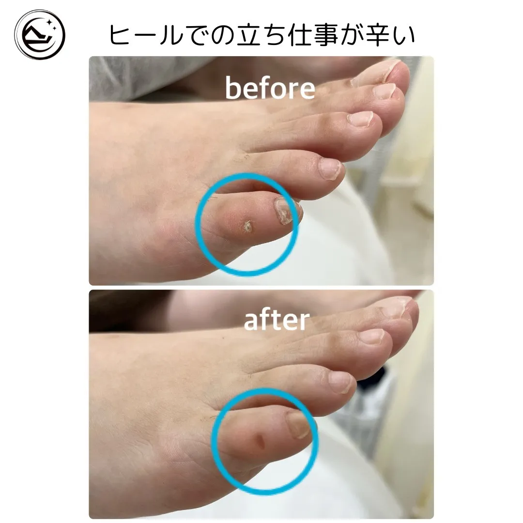 👠【小指の魚の目が痛くて立ち仕事が辛い😭】