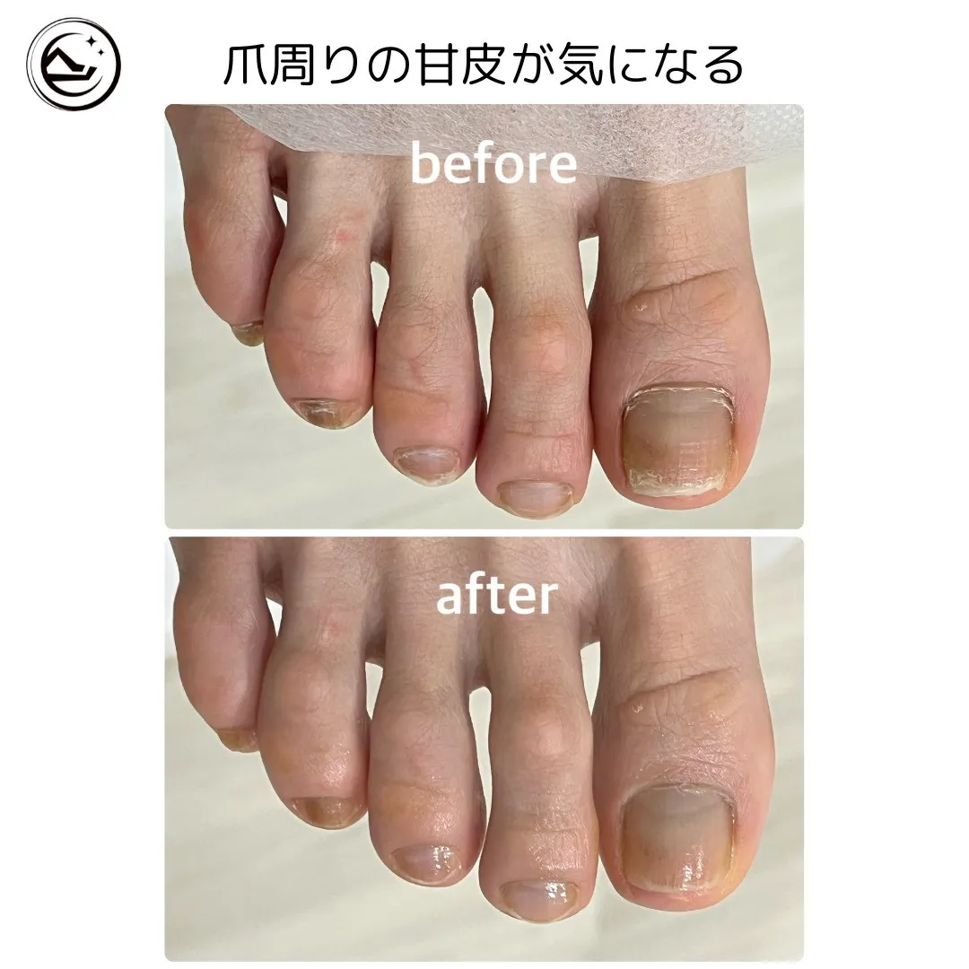 💅【甘皮がガサガサで気になる…そんなお悩みに✨】
