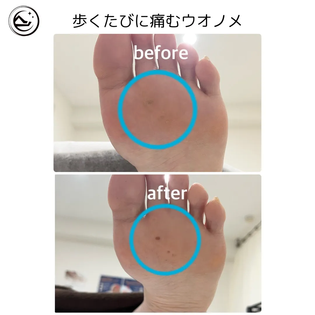 👣【歩くたびにズキッ…魚の目のお悩みに💡】　