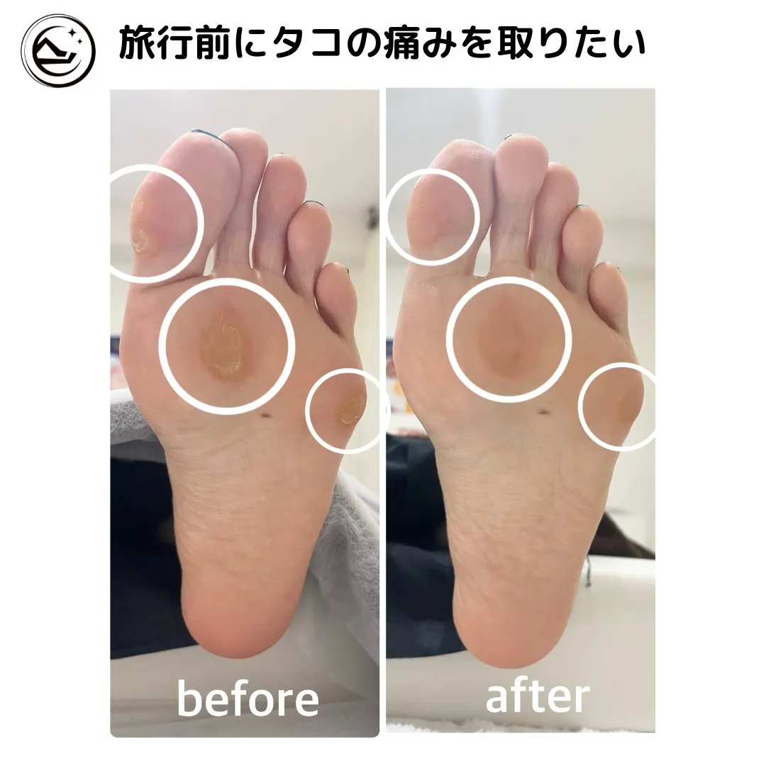 ✈️旅行前の足裏角質ケア👣