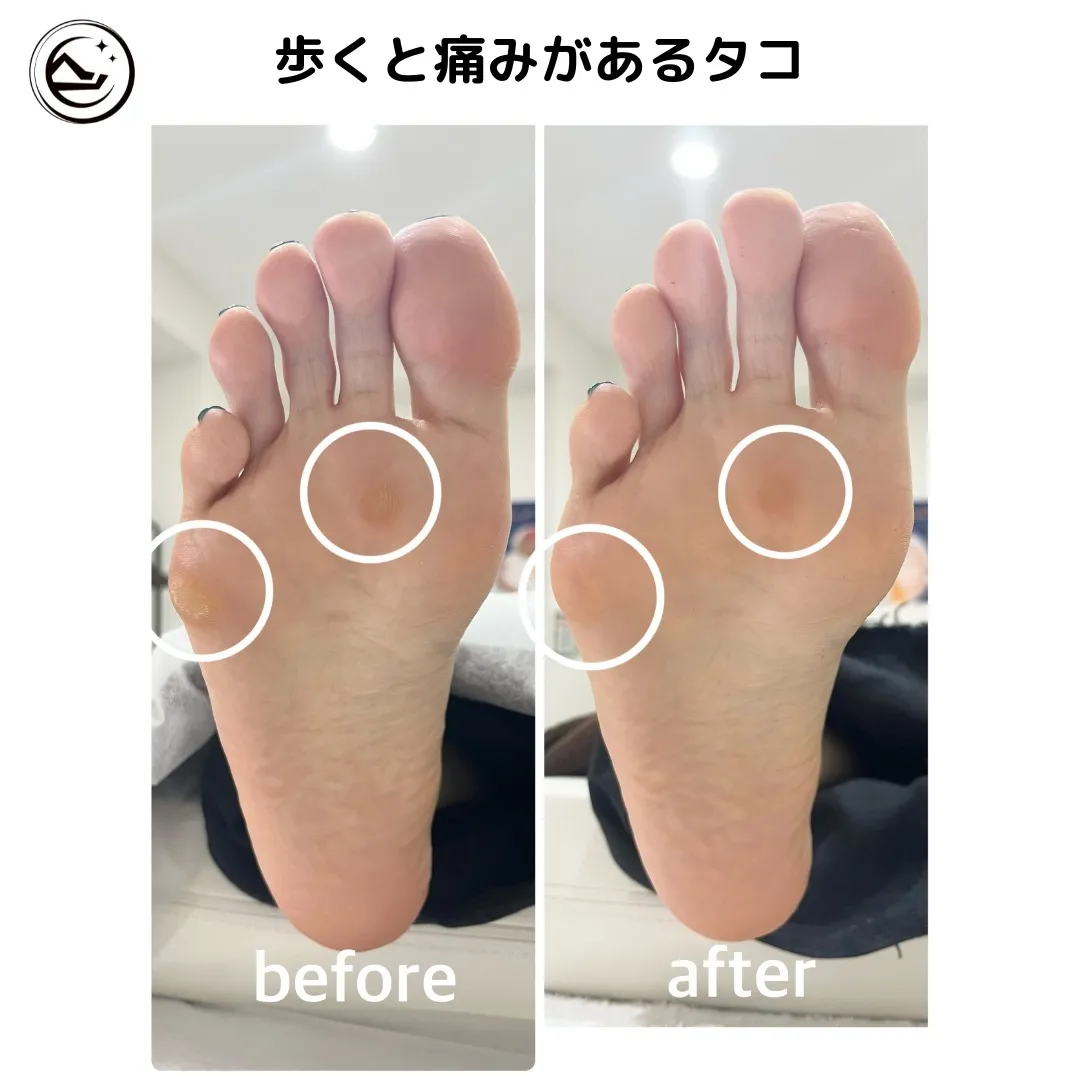 👣【歩くたびに痛い…タコのご相談】