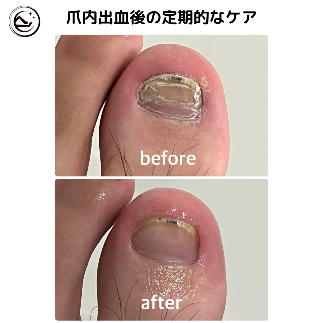 📸【爪ケア Before→After】📸