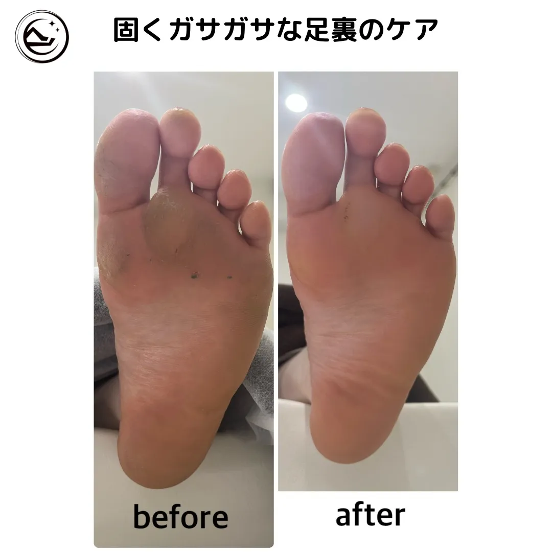 📸【角質ケア Before→After】📸