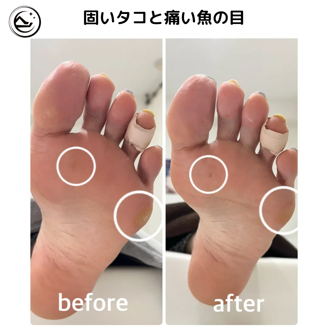 【タコ・魚の目ケア Before→After】