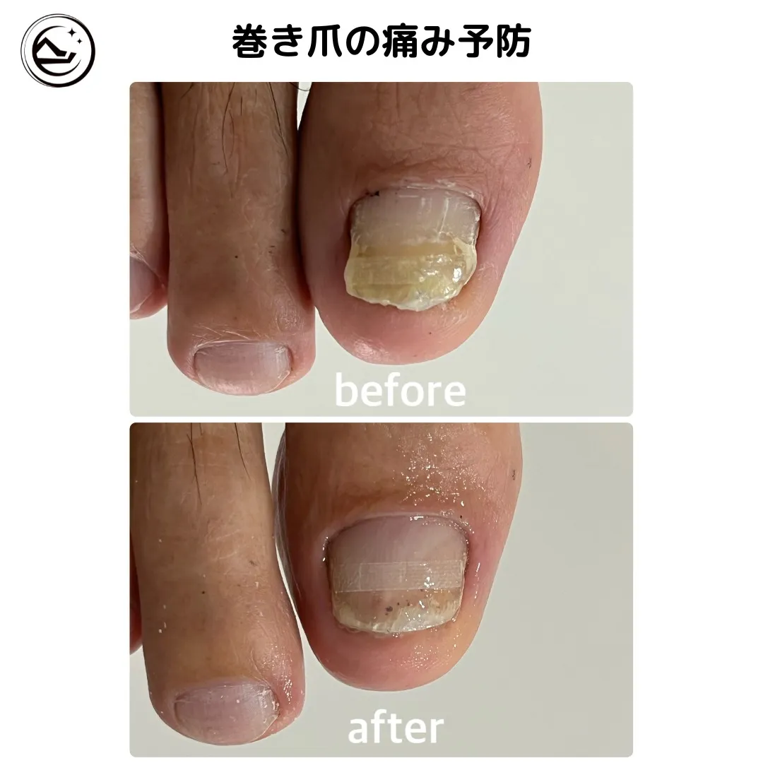 【巻き爪ケア Before→After】