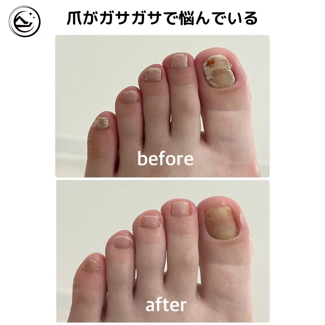 📣【ネイルケア Before→After】📣