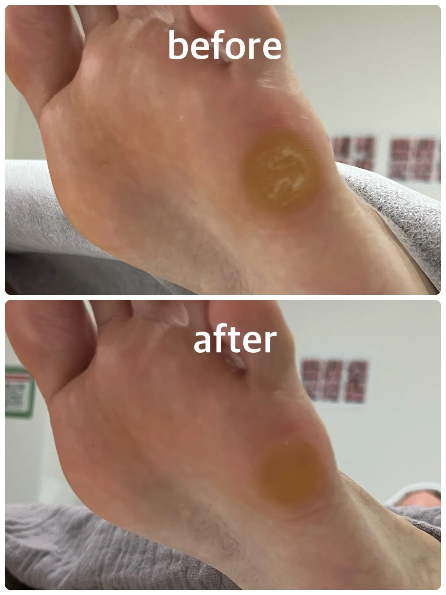 👣【角質ケア Before → After】👣