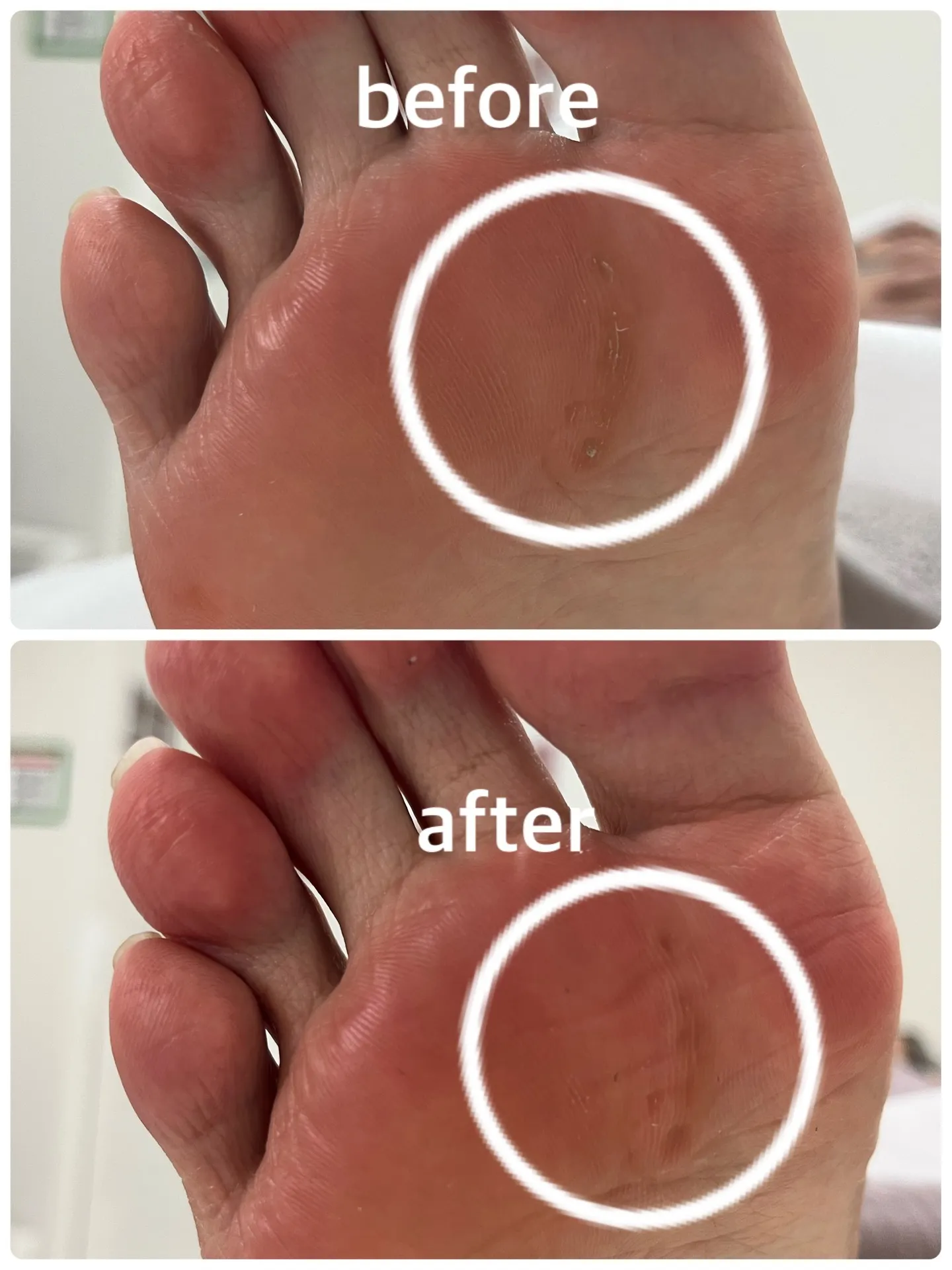 【角質ケア Before → After】