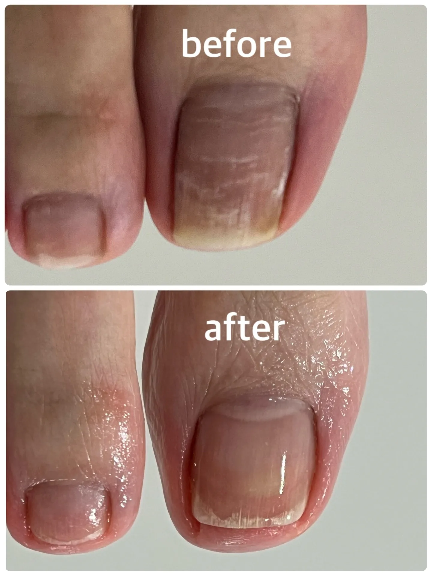 【巻き爪ケア Before → After】