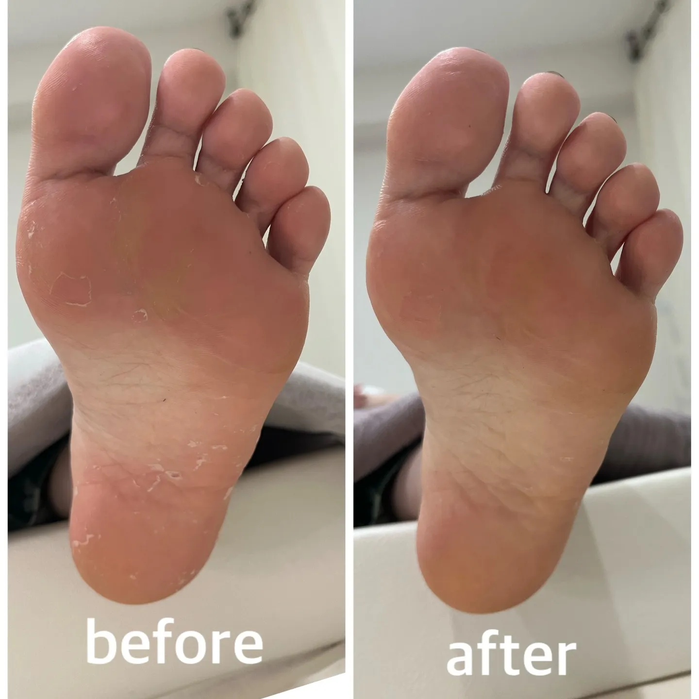 【角質ケア Before → After】