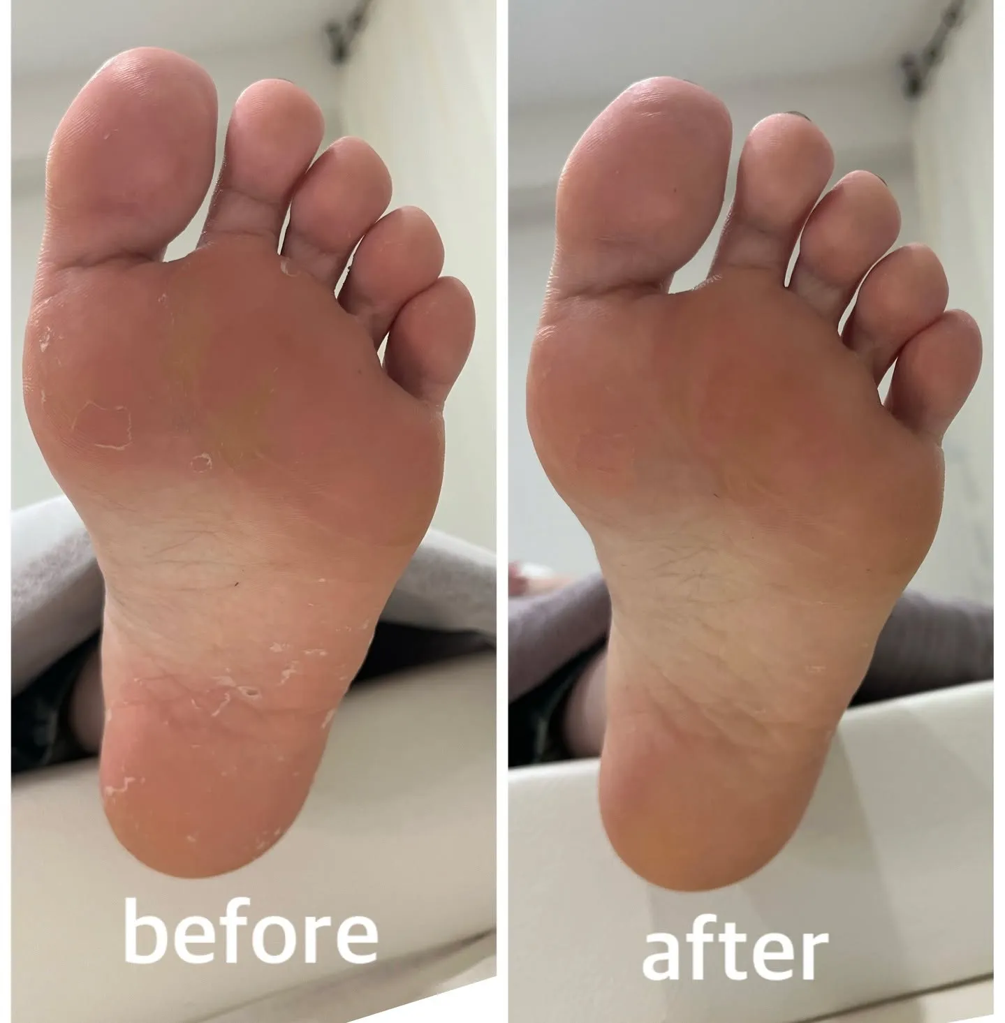 【角質ケア Before → After】