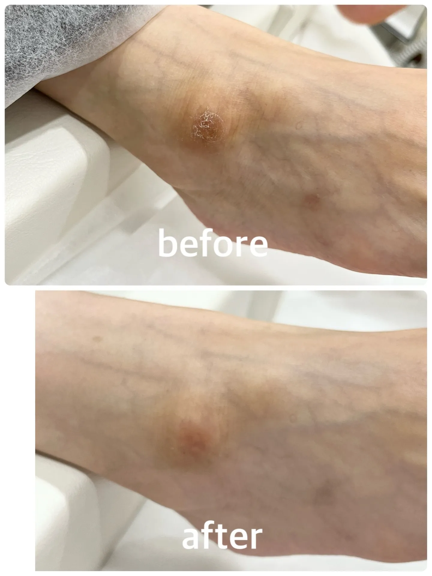【角質ケア Before → After】