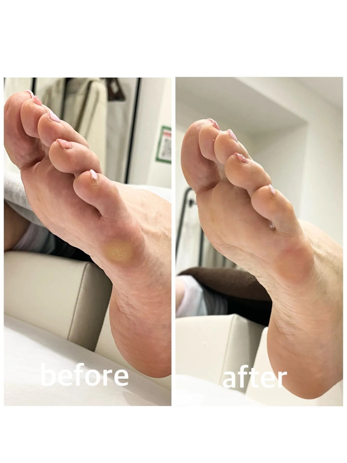 【角質ケア Before→After】