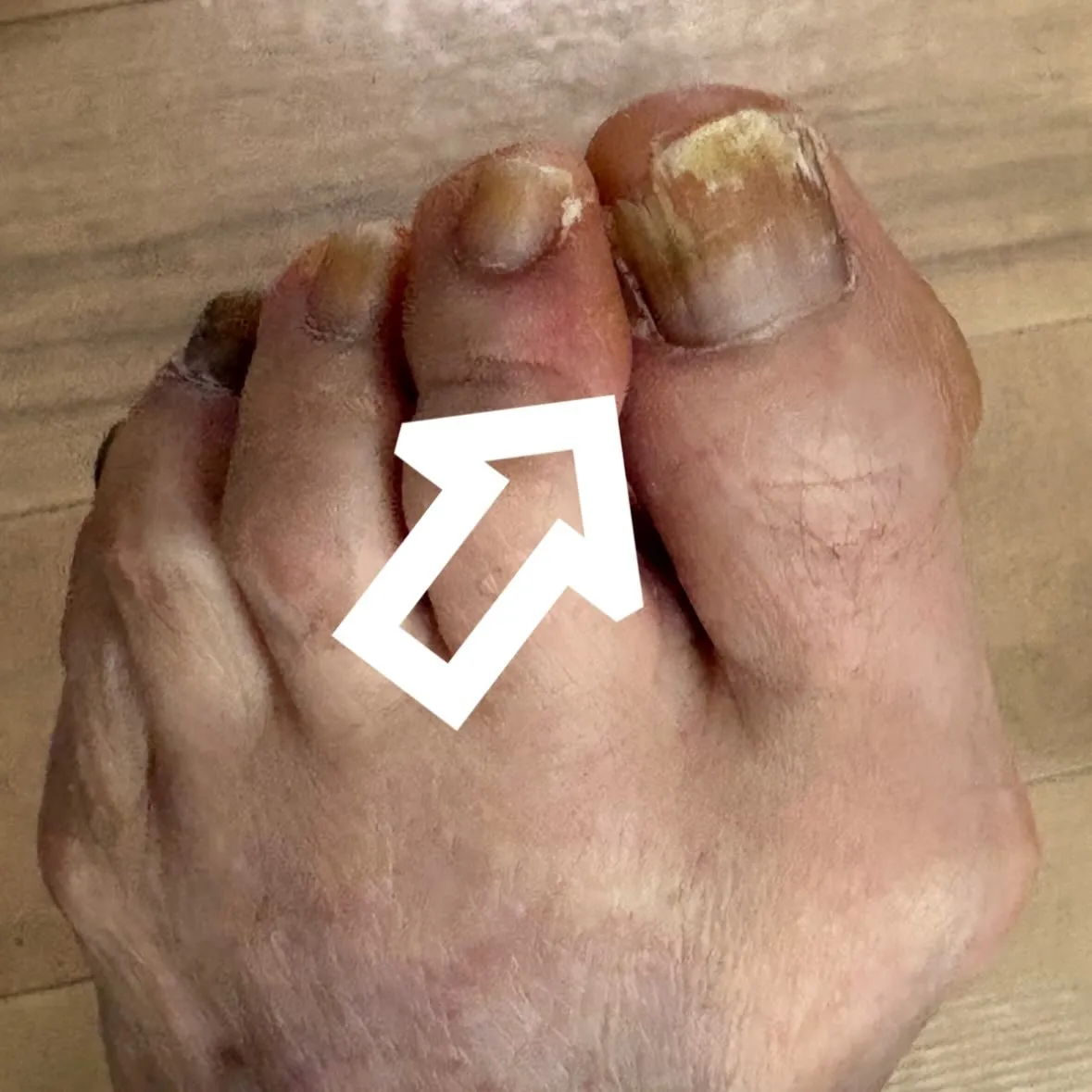 足のお爪のご相談として、